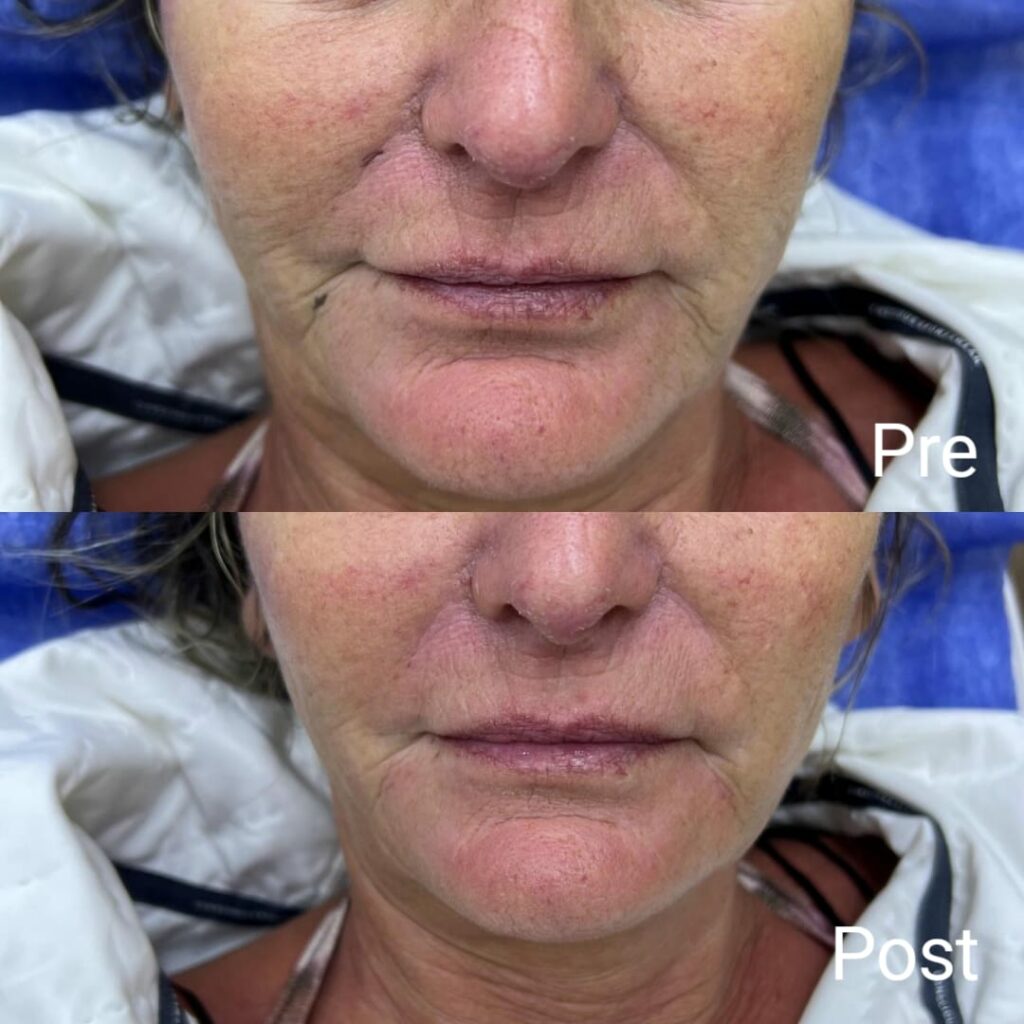 هياليرون خطين الابتسامه و حول الفم